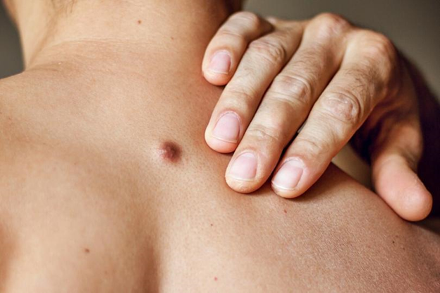 What Is Soft Fibroma And How To Treat It