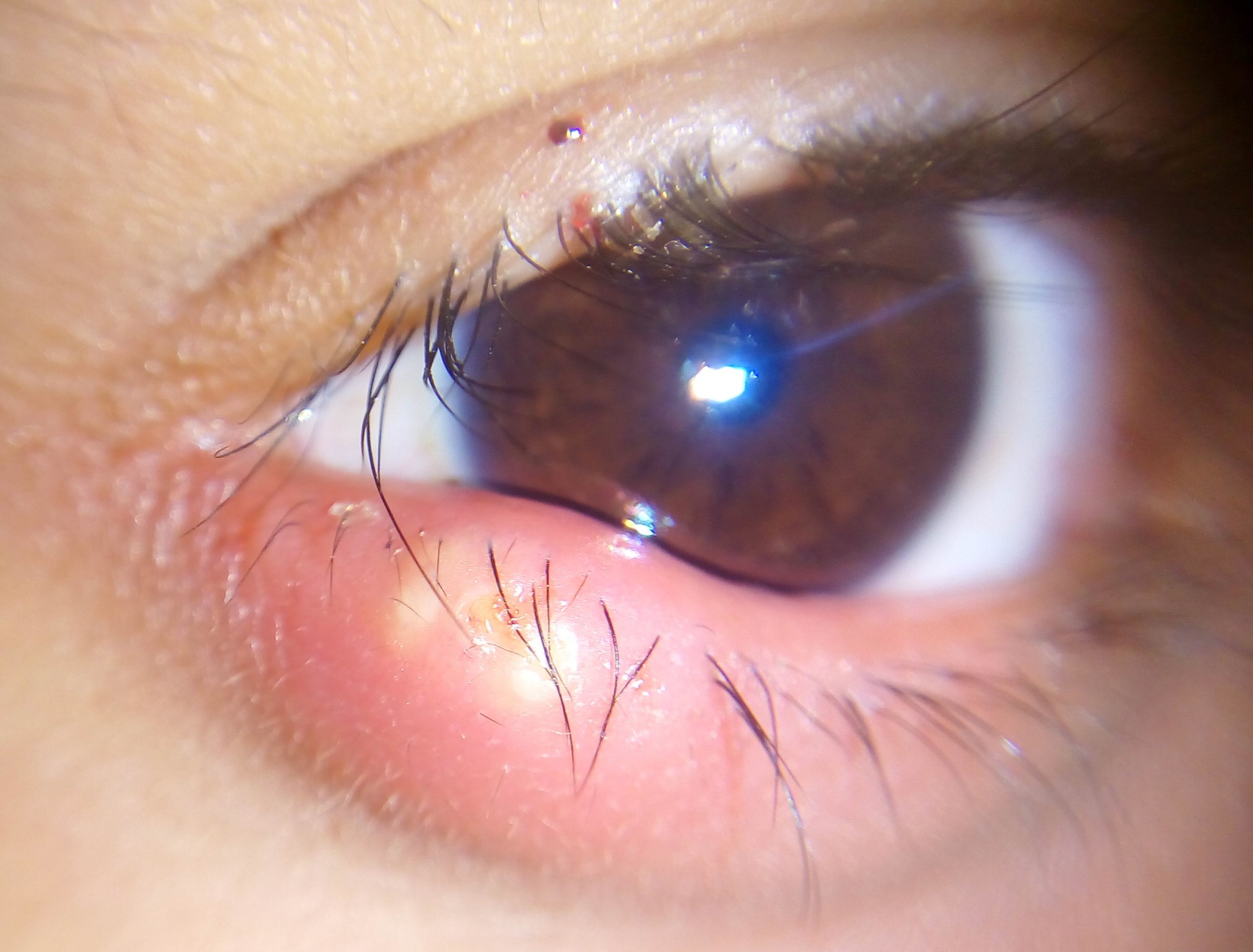 Sty Eye: 4 Ways To Get Rid Of Sty Eyes Quickly